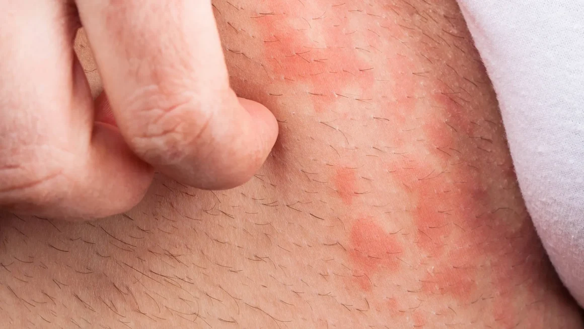 Nesselsucht: Was tun? (Ursachen, Symptome, Behandlung)